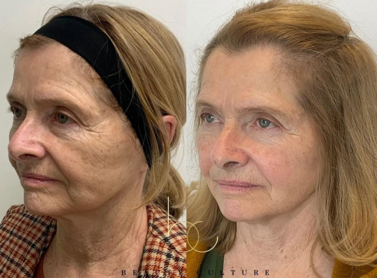 Före & efter — ansikte (referensbild från tillverkaren)