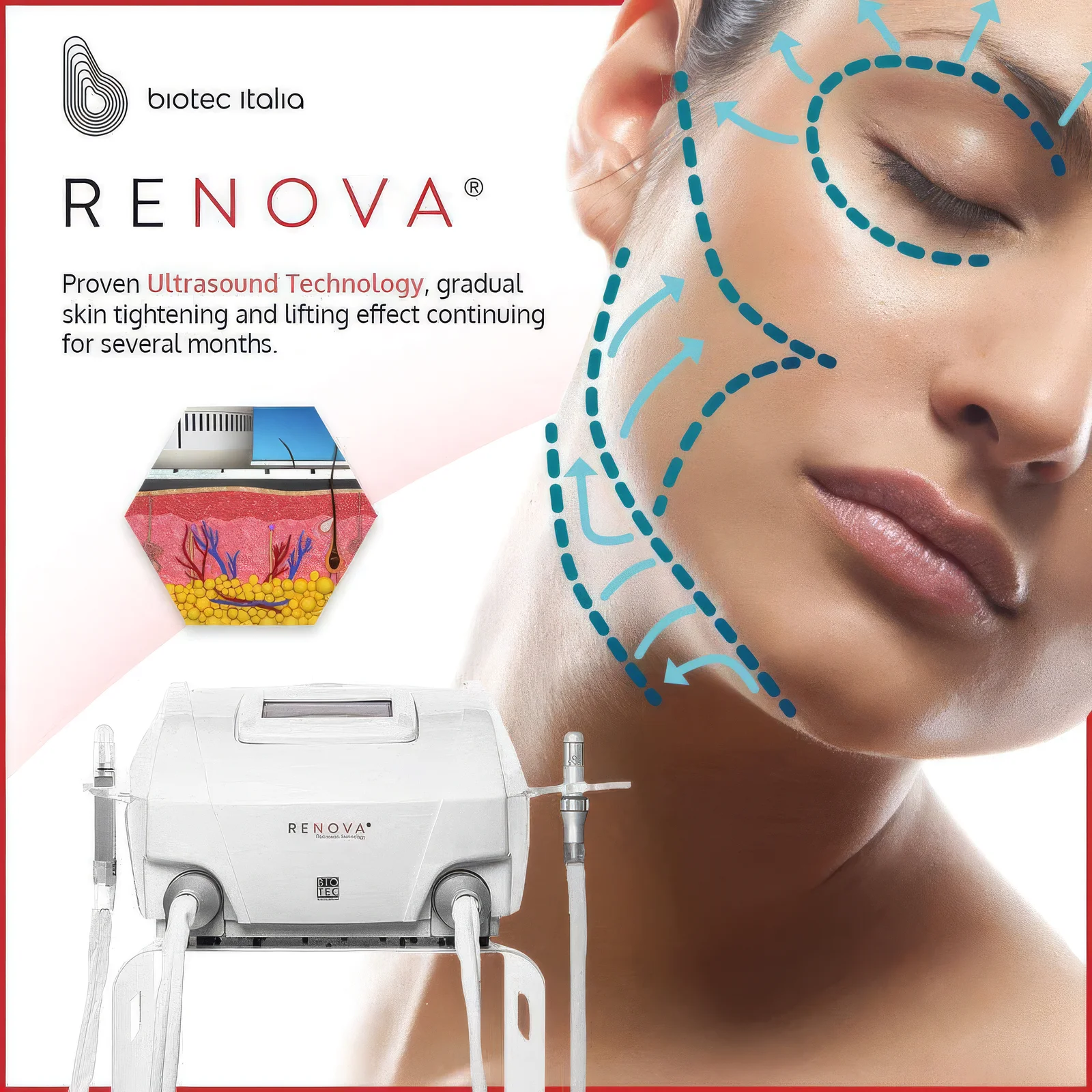 Renova HIFU — illustration av ultraljudsbehandlingen (Biotec Italia)